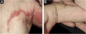 CHILD nevus, showing Blaschkoid lesion in fold area of ​​a newborn patient (a) without treatment (b) after two months of use of topical 2% Simvastatin + 2% Cholesterol.