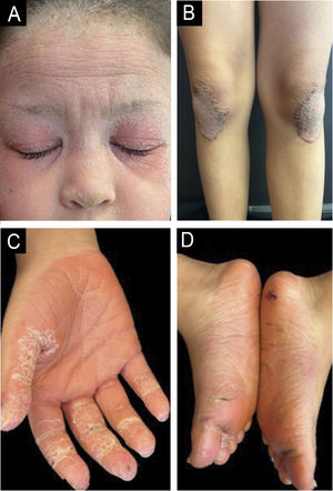 (A‒B) Erythematous, scaly plaques with follicular accentuation on the face and knees. (C‒D) Diffuse, symmetrical, orange, waxy palmoplantar keratoderma with fissures.