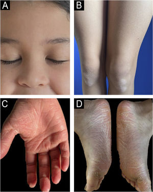 (A‒B) By the five-month follow-up, only post-inflammatory hypopigmentation remained on the knees, with complete resolution in the face and scalp. (C‒D) Marked reduction in palmoplantar keratoderma.