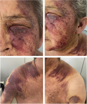 Presence of an extensive violaceous-purpuric plaques with some infiltrated areas on the left hemiface, neck, sternum, shoulders, breasts and axillae.