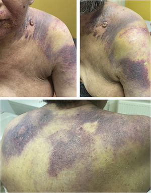 Cutaneous improvement with diminution of the violaceous plaques in the upper body and face after starting Erlotinib.
