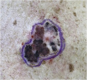 Asymmetrical multicolored brownish, blackened, grayish macular lesion with reddish areas and irregular edges.