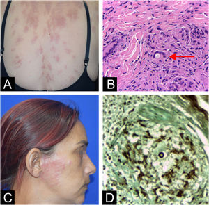 Patient 3 (A) Red plaques disseminated on the trunk and (B) Yeast inside giant cell (arrow) at hematoxylin eosin stain. Patient 4 (A) Pre-auricular red plaque and (D) Dermal granulomas showing an isolated yeast element at Grocott stain.