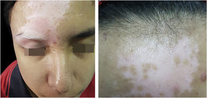 (A) Fourteen-year-old male patient diagnosed with vitiligo, presenting with an achromic patch involving the glabellar region and extending to the right upper eyelid, associated with poliosis of the right upper eyelashes. (B) Same patient after 12 biweekly sessions of 308-nm excimer light phototherapy with good responses and signs of repigmentation.