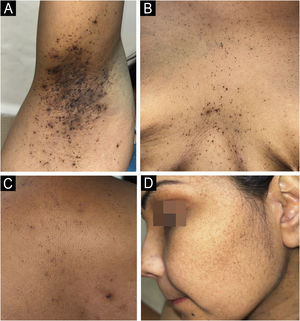 Clinical photographs showing multiple follicular hyperpigmented macules and comedo-like papules distributed over the axillae (A), intermammary region (B), and upper trunk (C), Facial involvement with scattered atrophic macules and follicular pits (D).