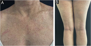 Clinical image. Complete response of both dermatoses after initiation of adalimumab and discontinuation of acitretin at week-8 (A, pre-esternal region; B, legs).