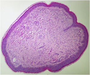 Histopathological examination of discoid fibroma. Well-circumscribed discoid fibrovascular proliferation (Hematoxylin & eosin, ×40).