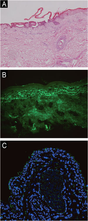 (A) Histopathological examination on the abdomen lesions at first (Hematoxilyn & eosin, 100×). (B) Direct immunofluorescence showing intercellular deposition of IgG in the epidermis (400×). (C) Negative indirect immunofluorescence on a rat bladder epithelium (serum dilution 1:20, 40×).