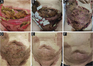 Clinical presentation in refractory patient of pemphigus vulgaris before and after telitacicept therapy. (A) On admission, (B) 2-weeks, (C) 3-weeks, (D) 6-weeks, (E) 10-weeks, (F) 18-weeks.