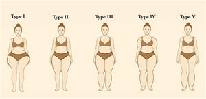 Graphical diagram representing the five subtypes of lipedema according to the distribution pattern.