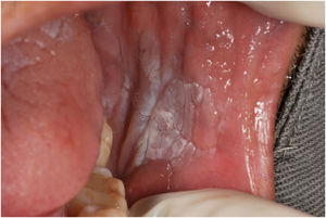 Initial image of the lesion in the buccal mucosa on the left side.