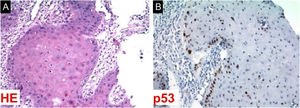 (A) Photomicrograph showing epithelium with high-grade dysplasia. (B) Immunohistochemical study revealing expression for the tumor suppressor gene TP53.