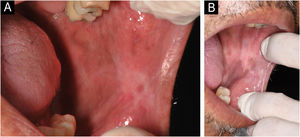 Appearance of the left buccal mucosa after 30 months. The pigmented areas are suggestive of melanosis due to smoking.