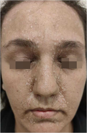 Multiple skin-colored papules (0.5–2 mm) symmetrically distributed over the central face, consistent with trichoepitheliomas.