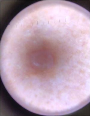 Dermoscopy demonstrating regular lesion architecture with well-defined borders, peripheral thin irregular vessels, and central opaque white areas.
