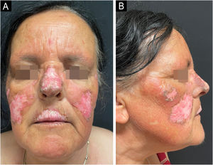 (A‒B) Chronic cutaneous lupus erythematosus of the face before treatment with Anifrolumab.