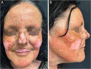 (A‒B) Chronic cutaneous lupus erythematosus of the face after only 8 weeks of treatment with Anifrolumab.
