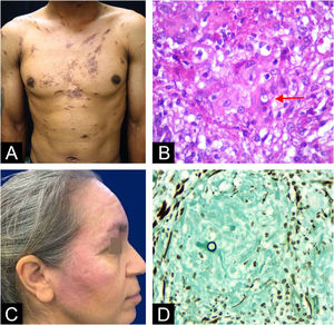 Patient 1 (A) Brownish plaques on the trunk and (B) A rare non-sporulating yeast element with thick wall in the dermis (arrow) at hematoxylin and eosin stain. Patient 2 (C) Red plaques on face and (D) Unique birefringent fungal structure within a dermal granuloma at Grocott stain.