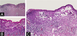 Varying degrees of dermal-epidermal detachment along almost de whole lesion (A – Hematoxylin & eosin, ×4); intact epidermis and grouped malignant melanocytes in the bottom, where superficial dermal infiltration is present (B ‒ Hematoxylin & eosin, ×10); intraepidermal (on the left) and subepidermal (on the right) multilocular cleft with pagetoid dissemination of isolated cells that reached the granulosa layer (C ‒ Hematoxylin & eosin, ×10).