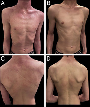 (A) Seventeen-year-old male patient diagnosed with atopic dermatitis presenting with pruritic, erythematous, and scaly plaques on the body and lower limbs. (B) Same patient after 18 biweekly sessions of nb-UVB phototherapy, showing significant clinical improvement.