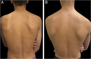 (A) Sixteen-year-old male patient diagnosed with chronic lichenoid pityriasis presenting with lichenified, scaly plaques on the lower back. (B) Same patient after 24 biweekly sessions of nb-UVB phototherapy, showing marked clinical improvement.