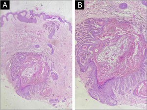Histopathological image showing elongated, branching (“antler-like”) rete ridges, basal hyperpigmentation, and follicular plugging, with sparing of the interfollicular epidermis (A ‒ Hemaxitolyn & eosin, 40×), (B ‒ Hemaxitolyn & eosin, 100×).