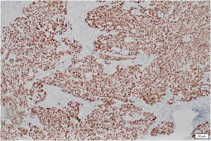Immunohistochemistry: tumor cells show positive staining for GATA-3.