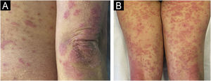 Clinical imaging. Erythematous plaques with silvery-white scaling on elbows (A) and posterior aspect of both lower limbs (B) after initiation of acitretin. Morphologic findings that are compatible with psoriasis.