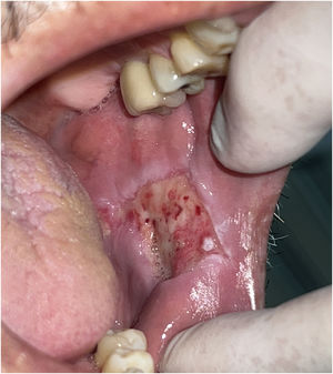 Representative image of healing seven days after surgery with a diode laser.