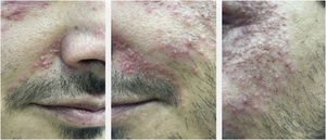 Close-up view of the skin lesions, showing hundreds of papules clustered on an erythematous background and some pustules. Photographs taken with a smartphone.
