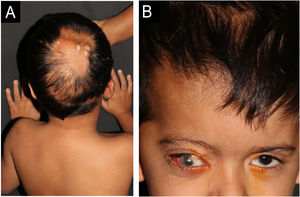 (A) Aplasia cutis over a normochromic alopecia patch in the vertex region; (B) Ipsilateral ocular lipodermoids and low-set right ear.