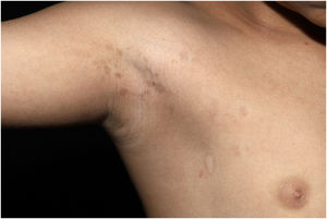 Axillary freckles ipsilateral to ocular and neurological findings.