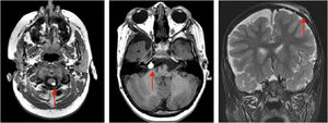 MRI demonstrating a lipoma in the right pontocerebellar cistern and a lipoma posterior to the cervical spinal cord. Subcutaneous tissue thickening is also observed in the right frontoparietal region, clinically corresponding to the alopecia area.