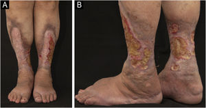 (A and B) Case 1. Ulcerated Necrobiosis lipoidica simulating venous ulcers. Ulcers are observed on the anterior, lateral, medial, and posterior aspects of the lower limbs, with fibrinoid tissue over an extensive atrophic plaque with a slightly yellowish center, brownish and purplish borders, affecting the entire distal circumference, associated with bilateral edema.