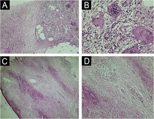 (A and B) Anatomopathological examination of Case 1 highlights multinucleated giant cells and the granulomatous arrangement around necrotic connective tissue (A – Hematoxylin & eosin, ×100; B – Magnified image; Hematoxylin & eosin, ×400). (C and D) Anatomopathological examination of Case 2 reveals alternating bands of necrotic connective tissue and areas of chronic inflammatory infiltrate in a palisade pattern, rich in lymphocytes, multinucleated giant cells, and plasma cells. Inflammatory cells are also distributed around appendages and vessels. The typical alternating architectural pattern resembles the layers of a cake (C – Hematoxylin & eosin, ×40; D – Hematoxylin & eosin, ×100).