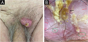 (A) Clinical image: Erythematous tumor with surface scaling located in the pubic region. (B) Dermoscopic image: Central keratin mass (black arrows), whitish areas (red arrows), erosions (green circle), and irregular, fine linear vessels (yellow arrow). (Illuco IDSfe-1100, 10×, polarized mode).