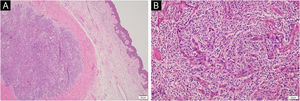 Histopathological study: (A) The epidermis shows hyperkeratosis and parakeratosis. A neoplasm arranged in nests infiltrates the dermis and hypodermis (Hematoxylin & eosin, 4×). (B) The neoplasm is composed of large cells with a high nucleus-to-cytoplasm ratio, moderate pleomorphism, and irregular nuclei. Up to five mitotic figures are observed per 10 high-power fields (Hematoxylin & eosin, 20×).