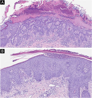 Histological images with hematoxylin and eosin-stained sections (×40). The first image shows acantholysis with dyskeratosis (numerous grains and corp ronds) as well as parakeratosis, findings suggestive of Darier