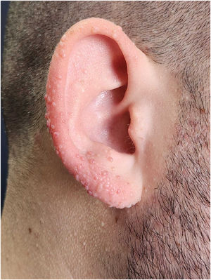 Discoid fibromas in Patient nº 1. Multiple skin-coloured small papules on the pinna.