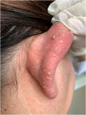 Discoid fibromas in his mother. Multiple skin-coloured papules on the pinna.