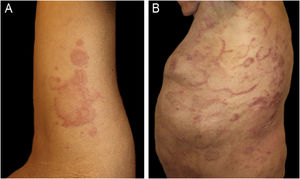 (A) Case 1: Annular plaques with erythematous borders on the right armpit and upper extremity. (B) Case 3: Erythematous macules and plaques with the typical figurate erythema aspect, on the trunk.