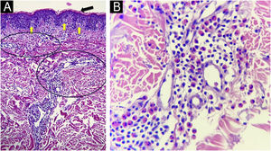 (A) Hematoxilyn & eosin, 100×. Epidermis with orthokeratosis (black arrow) and mild spongiosis (yellow arrows). Dermis with moderate inflammatory infiltrates of perivascular and interstitial disposition. (circles) (B) Hematoxilyn & eosin, 400 ×. A close up of the dermal infiltrates on a perivascular and interstitial disposition made up of lymphocytes and numerous eosinophils.
