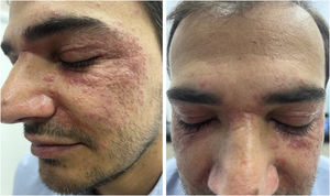 Multiple small erythematous papules, mostly grouped in plaques, on an erythematous base, on the periocular, nasolabial, and malar regions, symmetrically distributed. Photographs obtained with a smartphone.