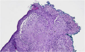Skin sections show epidermis with hypergranulosis. The superficial dermis shows granulomas of epithelioid cells, some with central areas of necrosis in a caseous pattern and surrounding lymphohistiocytic infiltrate with multinucleated giant cells. (Hematoxylin & eosin, ×40).