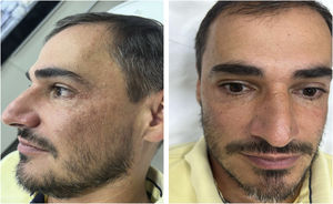 Patient after 4 months of treatment.