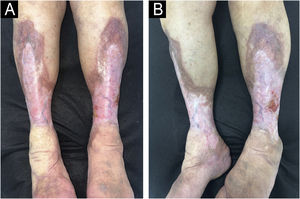 Case 1. Necrobiosis lipoidica with ulcers evolving towards healing. (A) Observe an extensive atrophic plaque with visualization of blood vessels, a slightly yellowish center, and brownish and purplish edges, affecting the entire distal circumference. (B) The single ulcerated lesion on the lateral aspect of the left leg is evident, superficial, and with good granulation tissue.