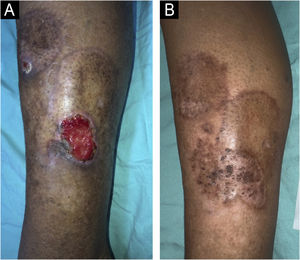 Case 2. (A) Chronic ulcer on the left lower limb over necrobiosis lipoidica. At this stage, a hydrocolloid dressing was used to maintain a moist environment and promote healing. (B) Healed ulcer.