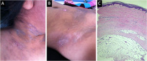 Female patient with cutaneous chronic graft-versus-host disease. (A) Sclerodermoid plaques involving the neck and upper chest. (B) Lesions affecting the skin of the lower abdomen, hip, and inguinal fold. (C) Skin biopsy showing epidermal atrophy with focal vacuolar degeneration of the dermal-epidermal junction. Marked fibrosis composed of parallel bundles of collagen in the superficial and deep dermis and subcutaneous tissue, with atrophy of cutaneous adnexal structures (Hematoxylin & eosin, ×10).
