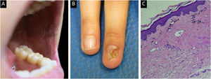 Female patient with lichenoid manifestations of cutaneous chronic graft-versus-host disease. (A) White reticulations on the buccal mucosa. (B) Nail changes with longitudinal ridging and pterygium formation. (C) Biopsy showing skin lined by a thin orthokeratotic epidermis with focal vacuolar degeneration of the dermal-epidermal junction and occasional dyskeratotic keratinocytes, accompanied by intraepithelial lymphocytes. The superficial dermis shows telangiectatic vessels, fibrosis, and numerous melanophages, with a reduction in cutaneous adnexal structures (Hematoxylin & eosin, ×10).
