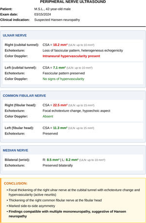 Example ultrasonographic report in leprosy. Focal thickening of the right ulnar nerve at the cubital tunnel (CSA 18.2 mm2; normal < 10 mm2), with loss of the fascicular pattern, heterogeneous echogenicity, and increased intraneural flow on color Doppler ‒ findings indicative of active neuritis. There is also thickening of the right common fibular nerve (CSA 22.5 mm2) with focal echotextural change. Comparison with the contralateral sides shows marked asymmetry. These findings are consistent with an asymmetric multiple mononeuropathy of leprosy pattern.
